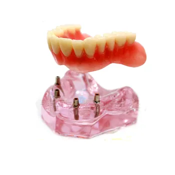Верхняя Зубная Протезная пластина Superior 4 Имплантата Демонстрационная модель 6001 02 Модель зубов